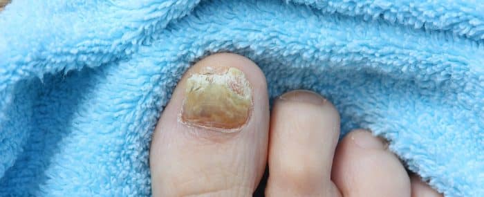 Eindeutig erkennbarer Nagelpilz Nagelpilz
