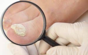 Nagelpilz früh erkennen Nagelpilz