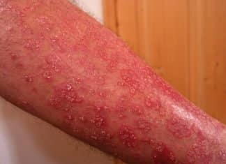 Schuppenflechte Behandlung schuppenflechte behandlung