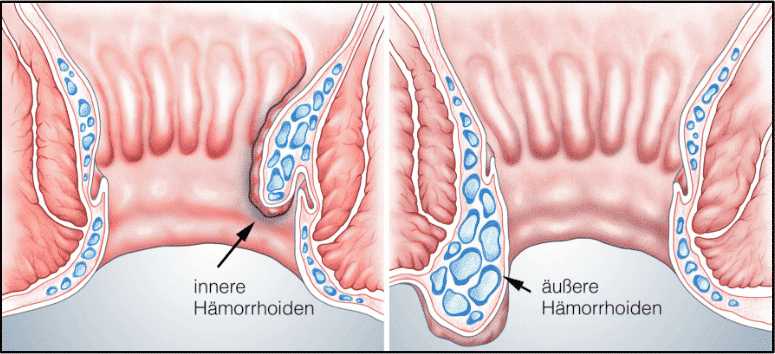 Jucken Bilder Von Aussenliegende Hamorrhoiden Test 8