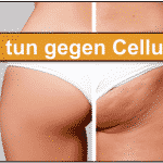 Cellulite : Ursachen und Lösung + 10 Sofort-Tipps gegen die Orangenhaut Cellulite Titelbild
