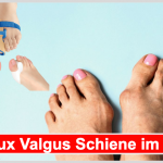 Hallux Valgus Schiene Test: 10 Hallux Valgus Schiene Hersteller im Vergleich Hallux Valgus Schiene Test Beitragsbild