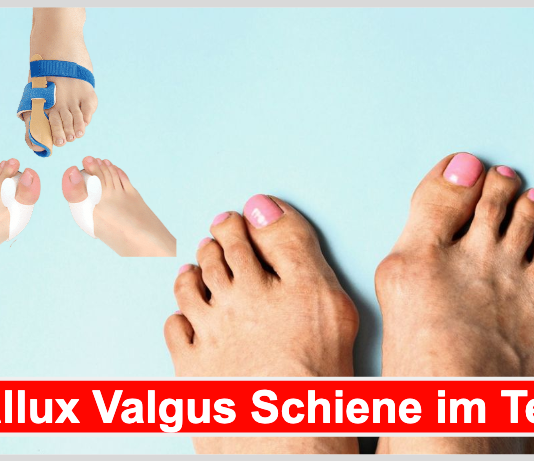 Hallux Valgus Schiene Test: 10 Hallux Valgus Schiene Hersteller im Vergleich Hallux Valgus Schiene Test Beitragsbild