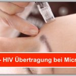 ACHTUNG! ▷ Microneedling – HIV Übertragung möglich, wenn die…