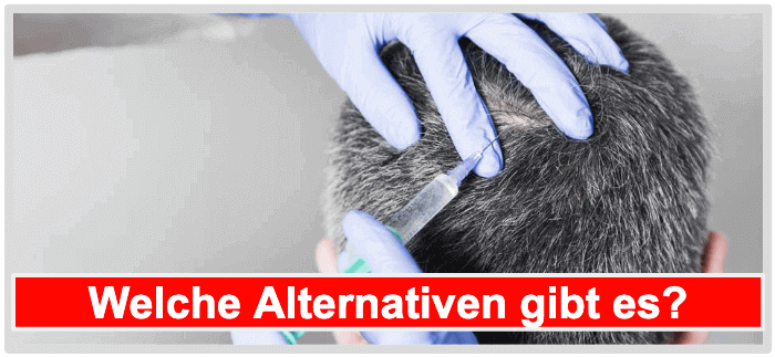 Haarwuchsmittel Alternativen Spritzen Immunbehandlung Microneedling Laserbehandlung Haartransplantation