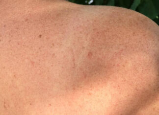 Das größte Organ der Menschen Haut