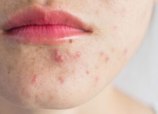 Unreine Haut wirksam behandeln